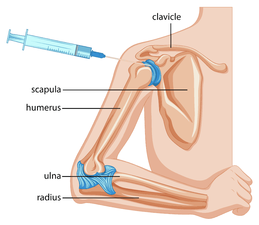 spinal injections steroid injection in shoulder ozone injection therapy injections for knee joint facet joint injection private steroid injections Hyaluronic Acid Injection hyaluronic acid injection knee cortisone injection knee joint